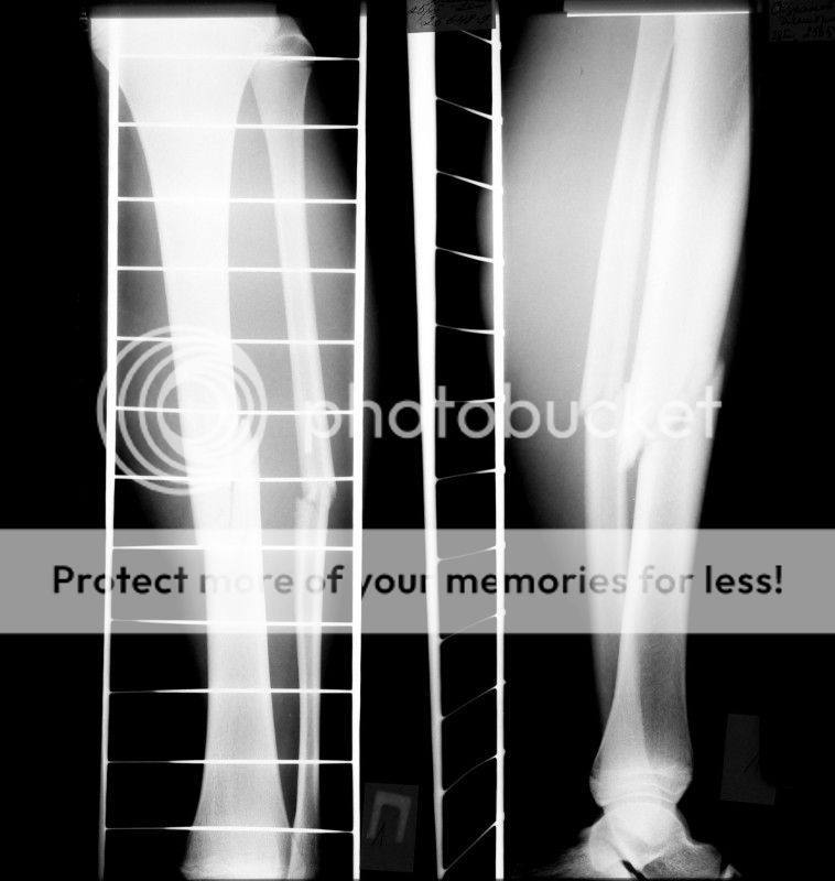 Сложный перелом ноги операция thumbnail